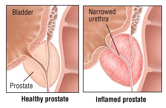 heath and inflamed prostate