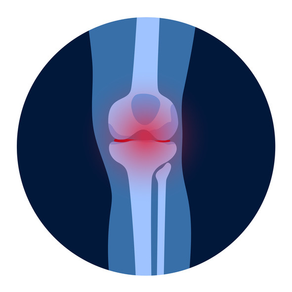 Stopping osteoarthritis: Could recent heart research provide a clue? - Harvard  Health