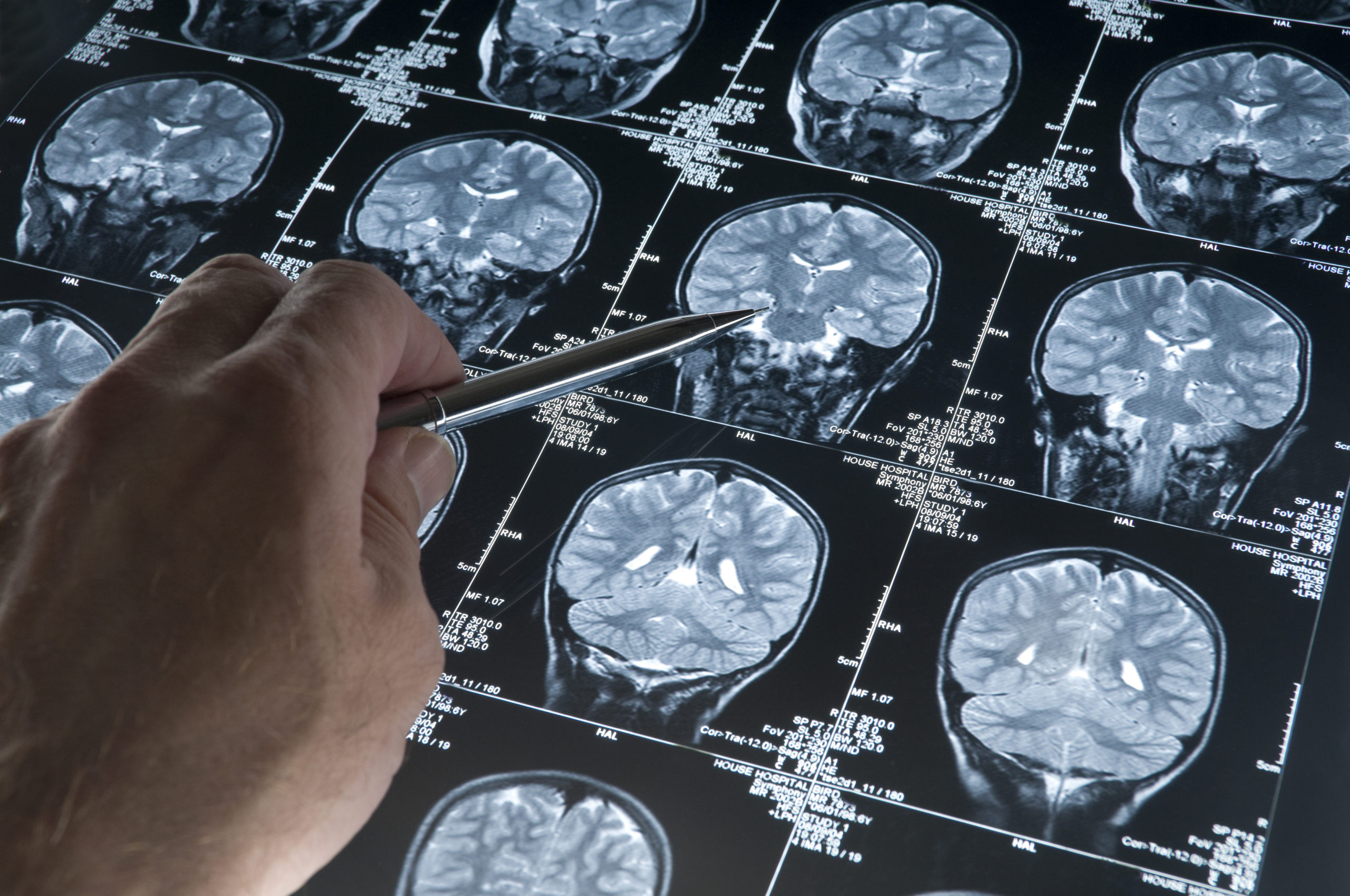 A new Alzheimer’s drug: From advisory panel to FDA — what’s at stake here?