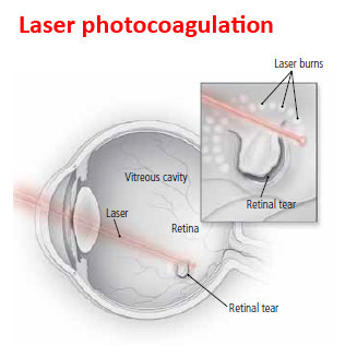 Laser photocoagulation is usually done in a doctor's office. The ophthalmologist uses a laser to make a series of tiny burns around the retinal tear. This creates a barrier of scar tissue that stops the tear from getting bigger.