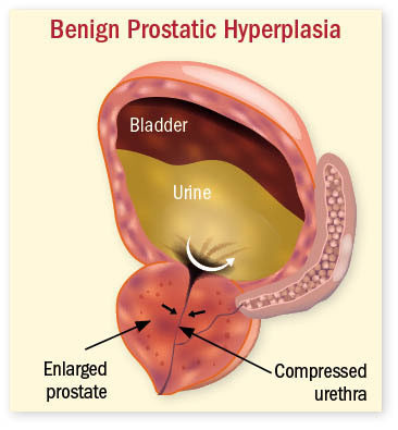 Steps to treating an enlarged prostate