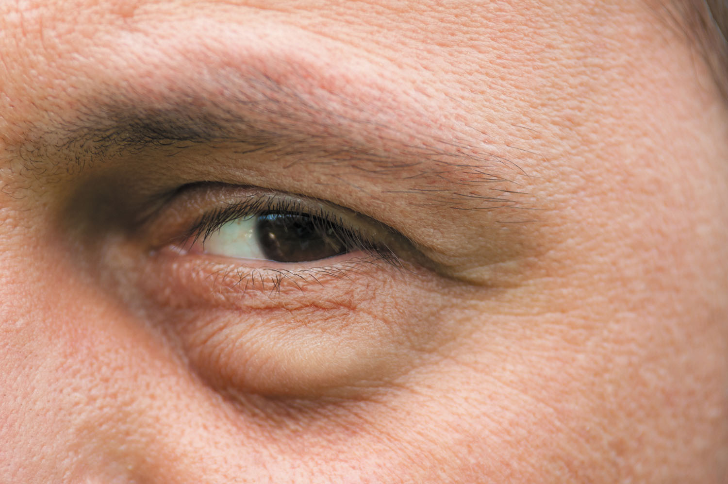 You don't say? Under eye bags and dark circles - Harvard Health