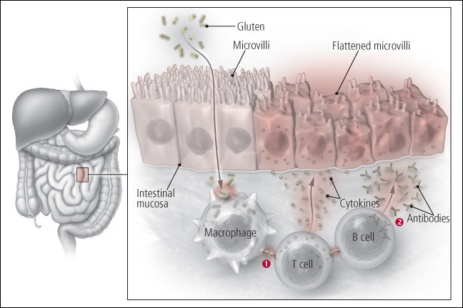 harvard medical school celiac research program