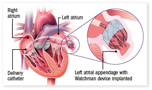 Stroke prevention in atrial fibrillation: Beyond anti-clotting drugs