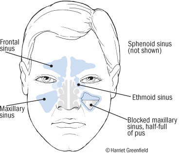 What does sinus store pressure feel like