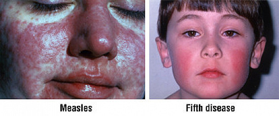 Rash featured image