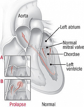 Mitral valve prolapse featured image