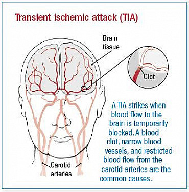 Transient ischemic attack (TIA) featured image