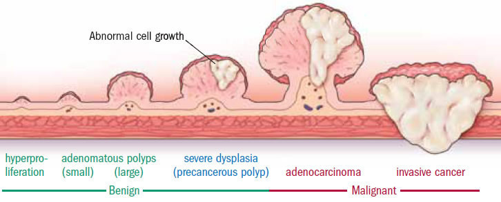 stages of colon polyps