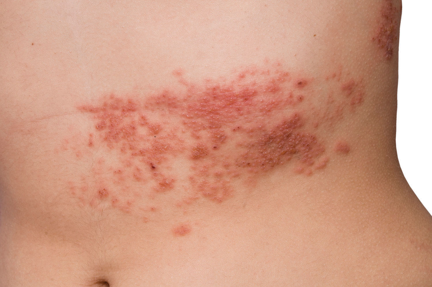 Answers To Common Questions About Shingles Harvard Health