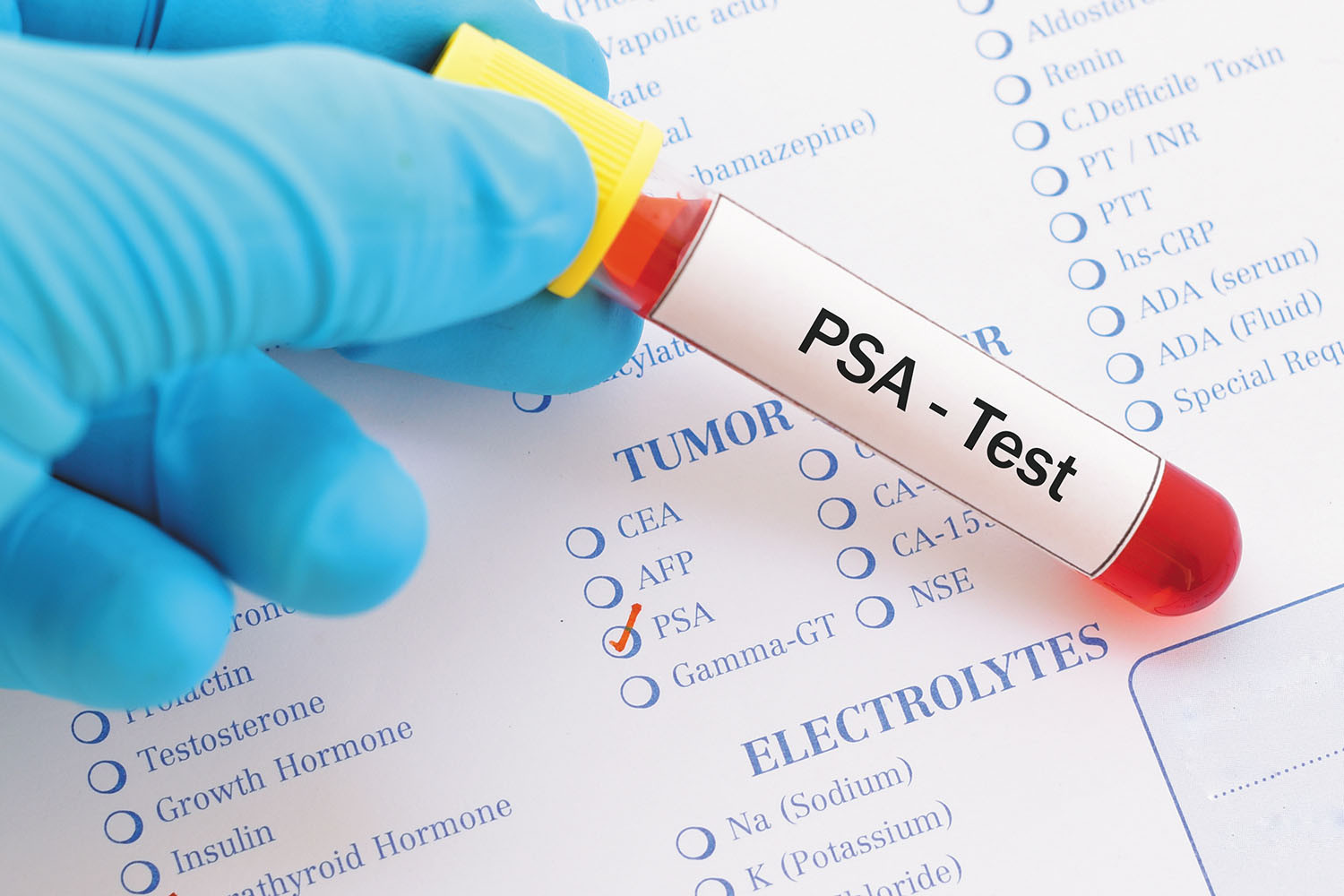 photo of a gloved hand holding a tube containing blood and marked PSA test on top of lab paperwork