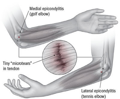Tennis Elbow Lateral Epicondylitis Harvard Health Tennis Elbow Lateral Epicondylitis Harvard Health