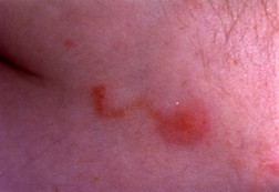close-up photo of skin of a person with scabies, showing red fulid-filled blisters