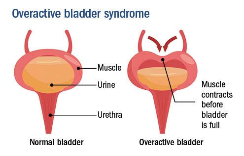 illustration showing behavior of a normal bladder versus an overactive bladder, with bladder muscle contracting before the bladder is full