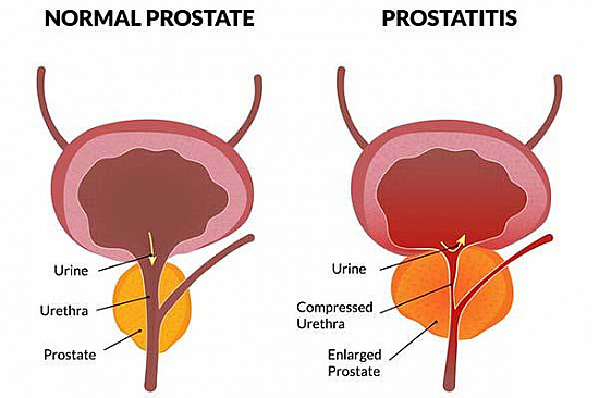 What Is Prostatitis And How Is It Treated Harvard Health