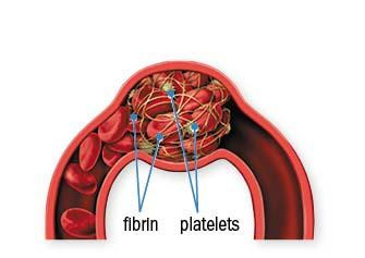 Illustration of a blood clot in an artery, with callouts pointing to fibrin and platelets inside the clot.