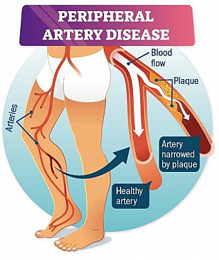 A new approach to peripheral artery disease featured image