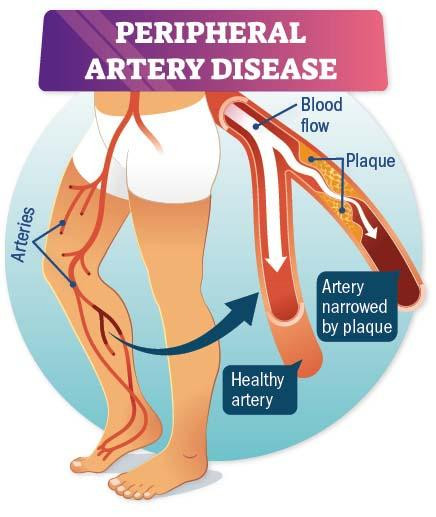 A new approach to peripheral artery disease
