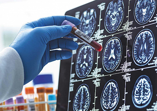 The new Alzheimer’s blood test: What it means for diagnosis featured image