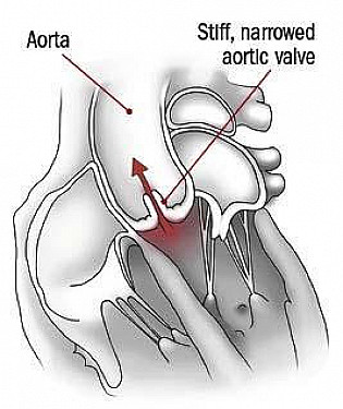 Can you slow down stenosis of the aortic valve? featured image