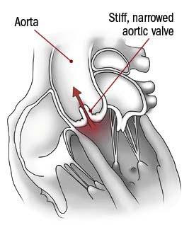 Cutaway illustration of a heart with callouts pointing to the aorta and a stiff, narrowed aortic valve.