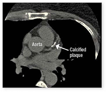 When incidental findings on scans reveal hidden heart disease featured image