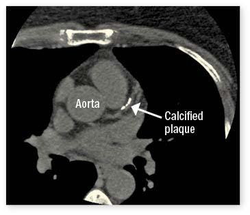A lung CT scan highlighting calcified plaque in the main artery of the heart.