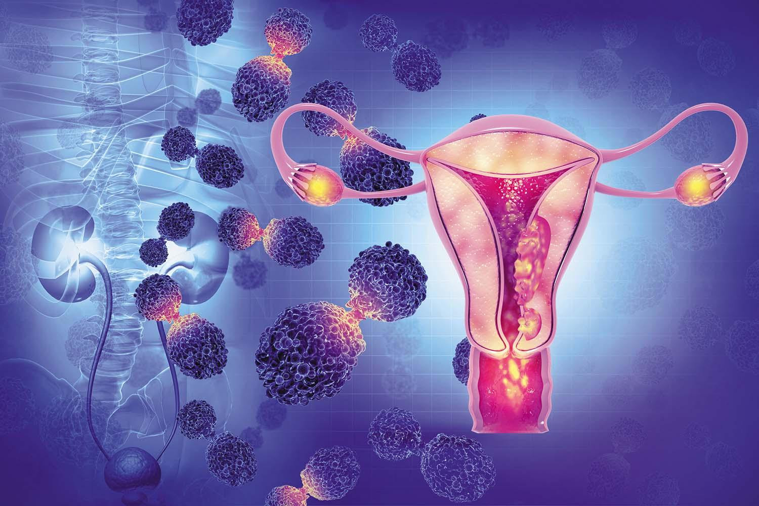 Illustration of female reproductive system in reds, oranges, and pinks on a blue background, showing areas where cancer can develop.