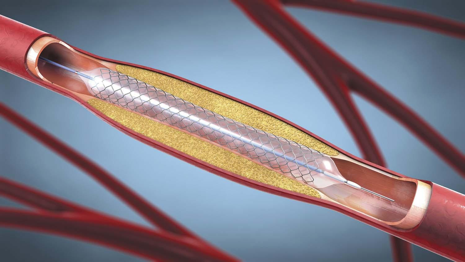 Cutaway illustration showing a stent positioned inside a blocked artery.