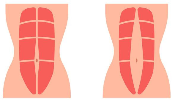 Illustration showing normal abdominal muscles on the left and diastasis recti on the right, with a divergence along the center line.