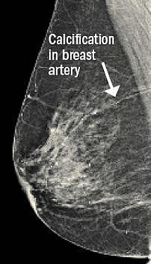 Machine learning used on mammograms may help predict heart disease featured image