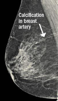 Image from a mammogram showing calcium deposits inan artery in the breast. 