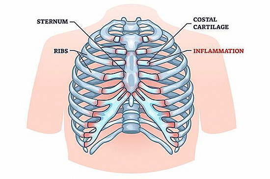 Chest pain that mimics a heart attack featured image