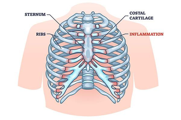Illustration of a human chest cavity with callouts pointing to the ribs, sternum, and costal cartilage, where inflammation caused by costochondritis can occur.