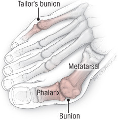 illustration of foot showing tailor's bunion