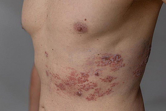 What to do if you have — or suspect you have — shingles featured image
