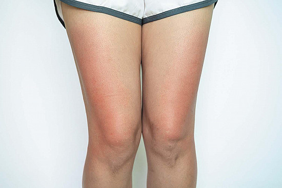 What is toasted skin syndrome? featured image