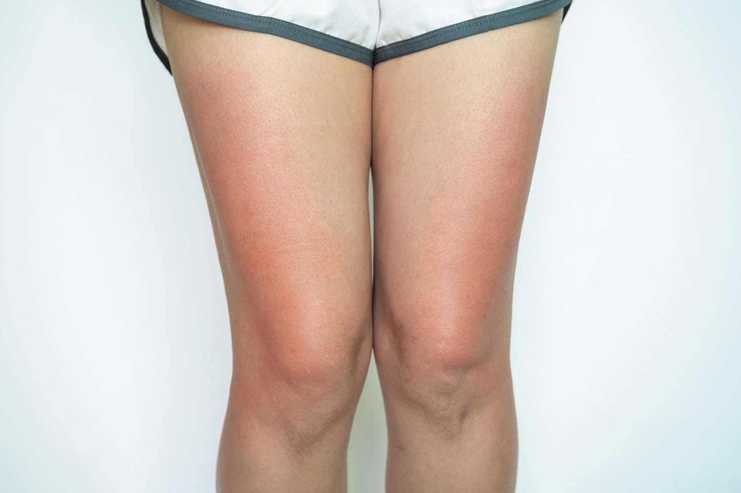 Cropped image of a woman's legs showing a red rash on the sides.