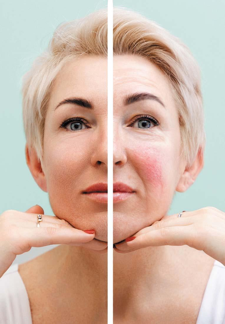Split image of a woman's face with one side showing a clear complexion and the other side showing rosacea.