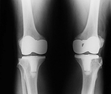 Two bad knees? What to know about bilateral knee replacement featured image