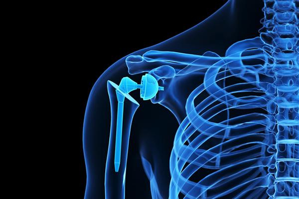Illustration of a human body with the skeleton highlighted and a shoulder joint replacement highlighted, all in blue against a black background.
