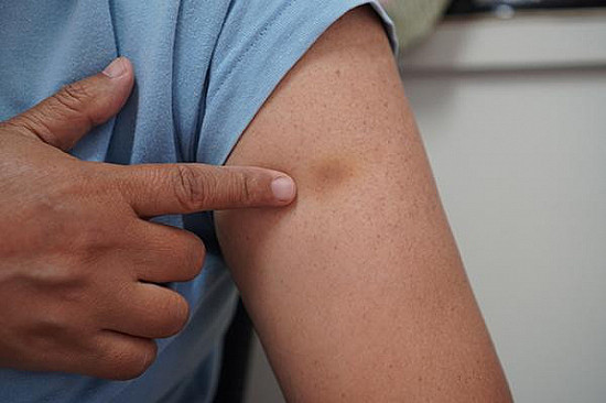 Why do I bruise so easily? featured image