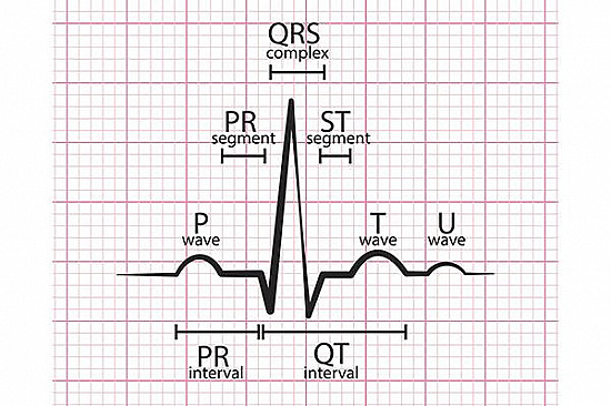 What is long QT syndrome? featured image