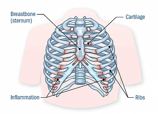 Chest pain that mimics a heart attack featured image