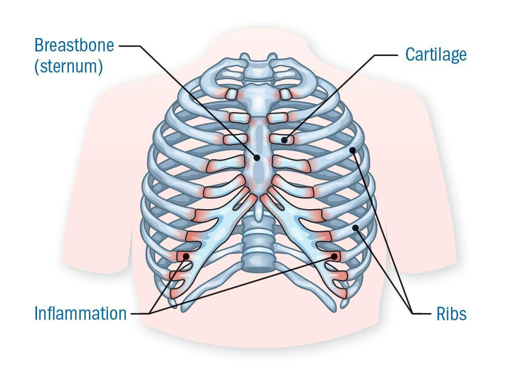 Chest pain that mimics a heart attack