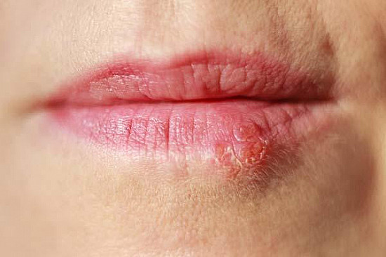 Is there a way to keep cold sores from coming back? featured image
