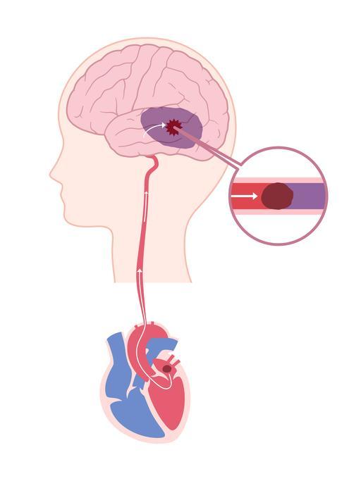 Illustration of cardiogenic cerebral embolism showing the connection between brain and heart, and a blow-up of a clot blocking an artery in the brain that can cause a stroke.