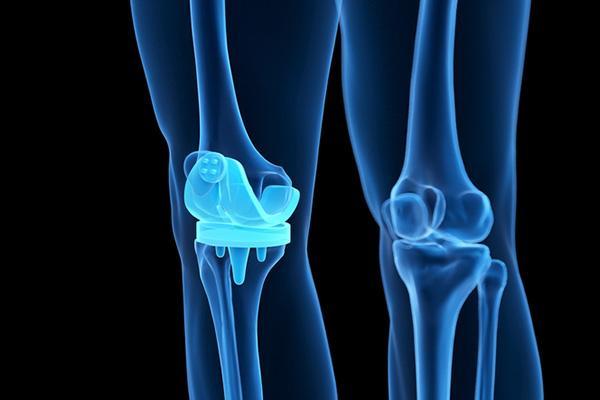 Advancements in knee replacement: More precise and personalized