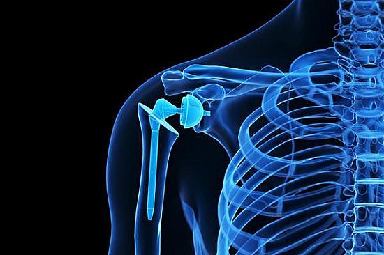Obesity appears not to raise risks from shoulder replacement surgery featured image