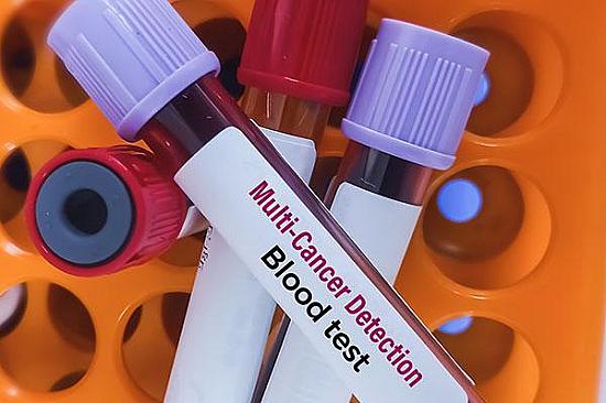 A blood test that checks for dozens of different cancers? featured image